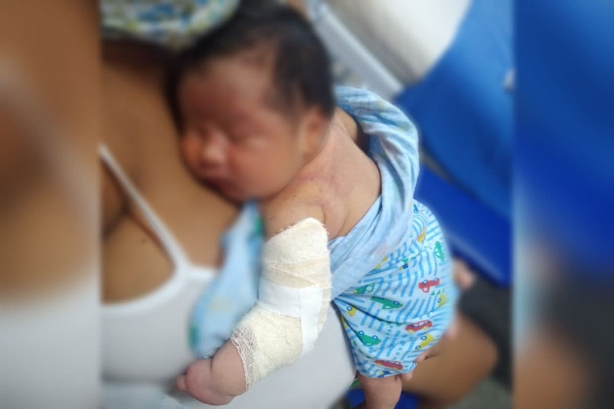 Bebê tem braço fraturado durante parto no Amazonas; saiba como ajudar a família