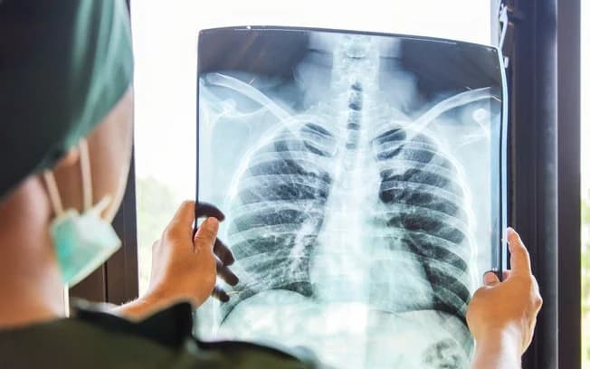 Amazonas, Rio de Janeiro e Acre lideram o ranking da tuberculose no Brasil