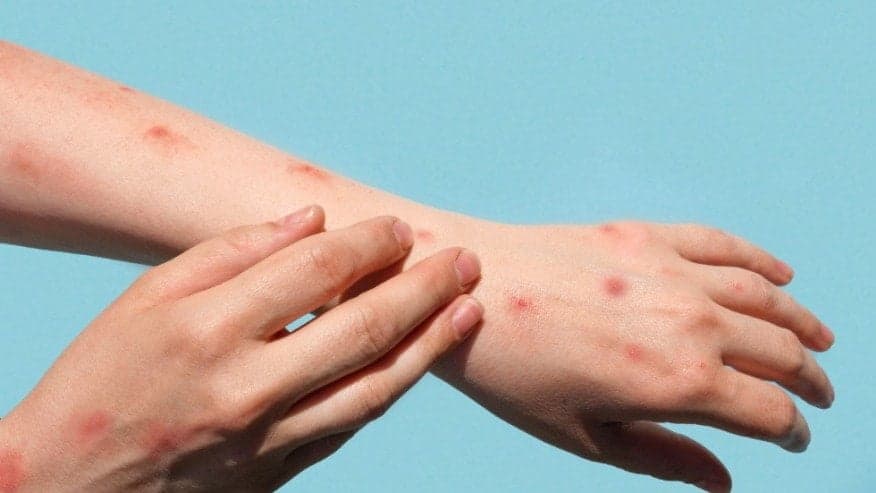 SES-AM confirma mais sete casos de Monkeypox no Amazonas