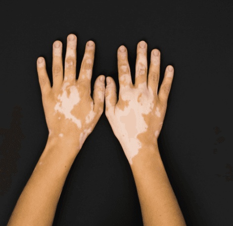 Vitiligo: em seis meses 118 casos são diagnosticados em Manaus. Conheça sintomas e tratamento