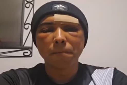 Brasileiro é agredido com taco na Irlanda: &#8220;Não tive tempo de me defender&#8221;