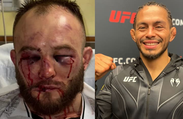 Lutador polonês mostra rosto desfigurado, após derrota para amazonense no UFC