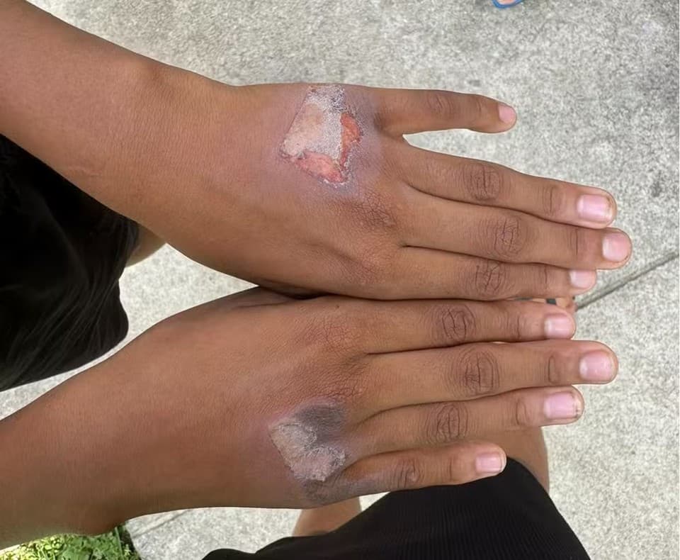 PE: Mãe é investigada por suspeita de queimar mãos do filho com chapinha: &#8220;Comeu iogurte sem permissão&#8221;
