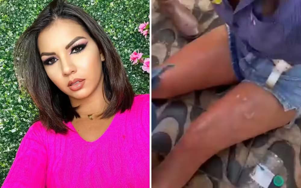 VÍDEO: &#8220;Sentimos a ardência e saímos correndo&#8221;, diz influenciadora após acidente em que mulher usou álcool em churrasqueira