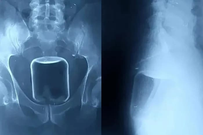 Na Rússia, homem passa por cirurgia para retirar copo de vidro inserido no ânus