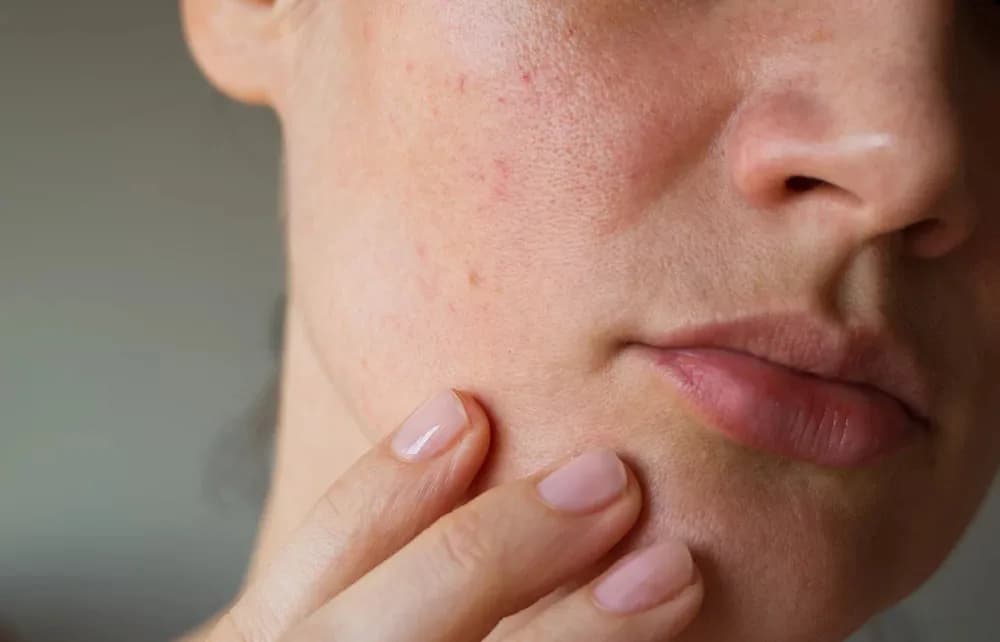 Como controlar a oleosidade da pele: dicas essenciais para manter a pele sequinha