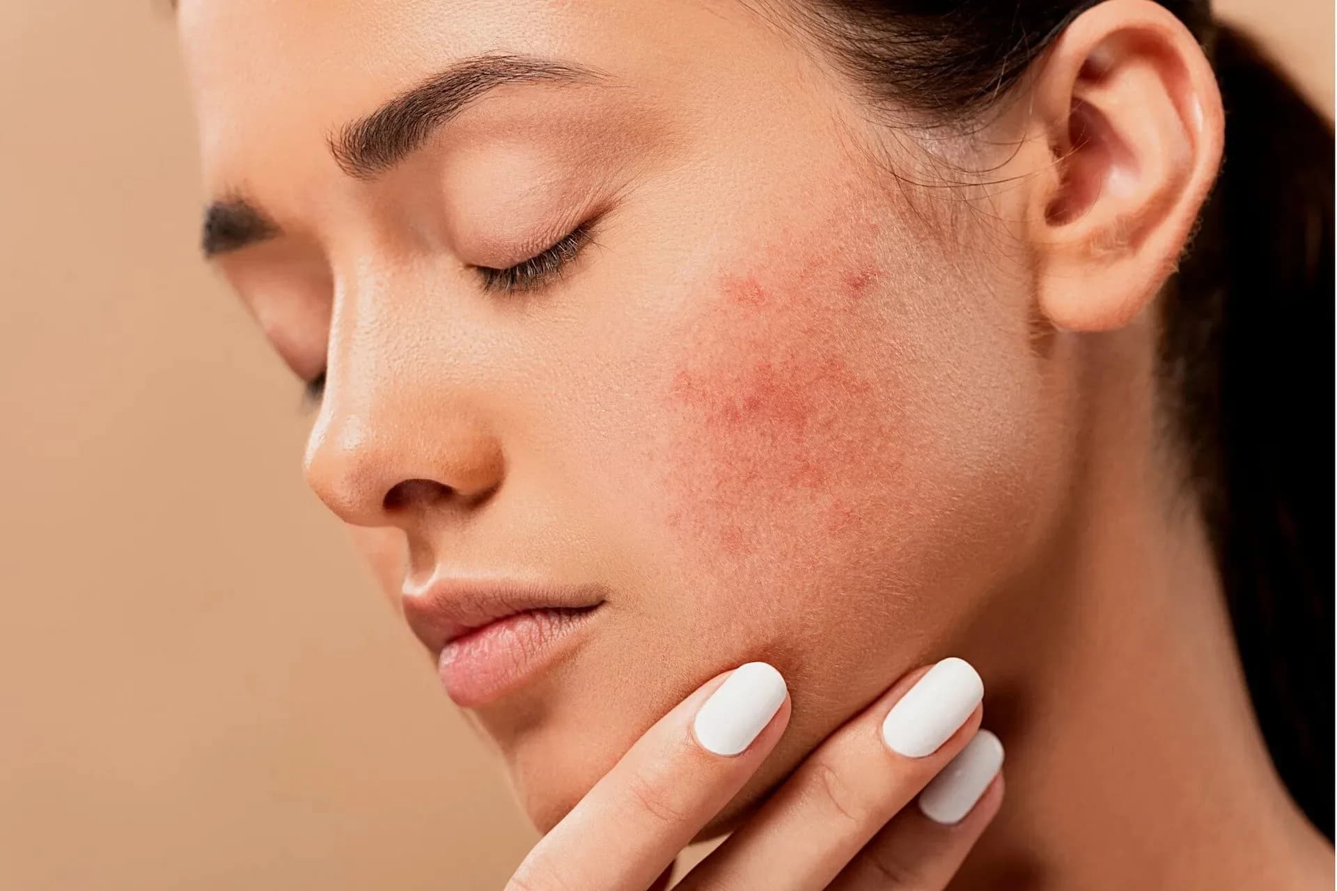 Cuidados essenciais para prevenir espinhas e evitar cicatrizes