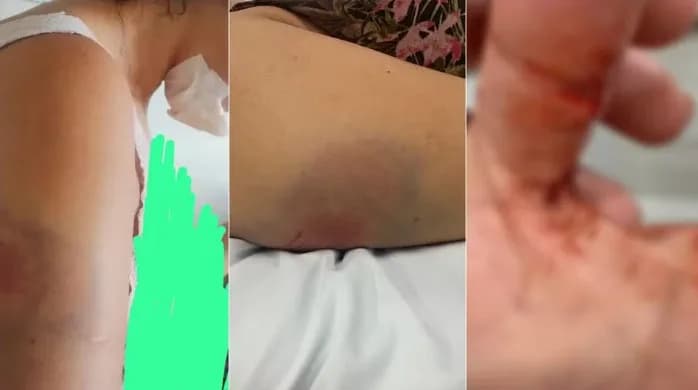 Em Fortaleza, mulher tem queixo destruído e lábios arrancados por marido 