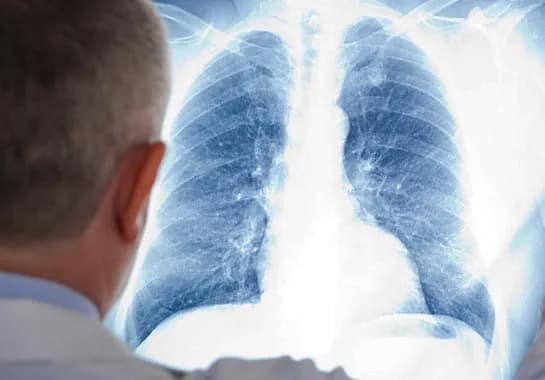 Dia Mundial da Tuberculose: Veja como diagnosticar a doença