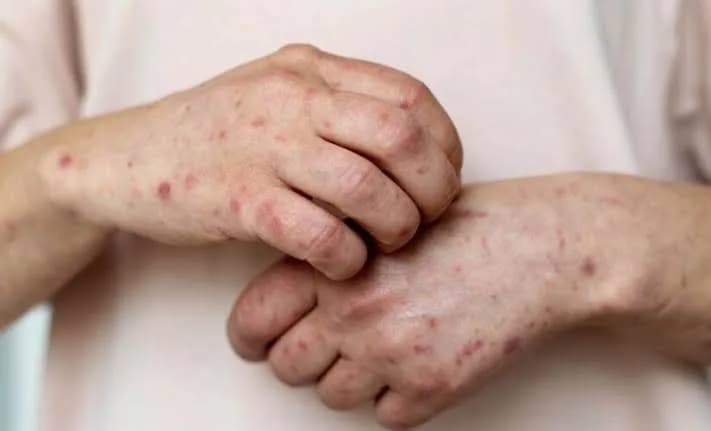 São Paulo registra primeiro caso de nova cepa de mpox no Brasil